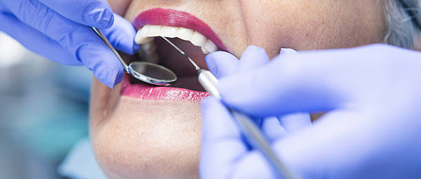 Best Emergency Dentist for Lost Fillings or Crowns in London, CA